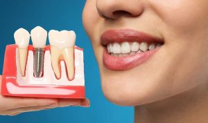 implantes dentales