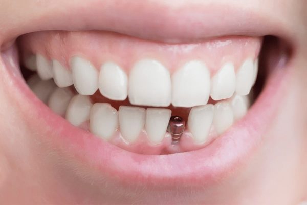sonrisa-mujer-mostrando-su-protesis-dental-fija