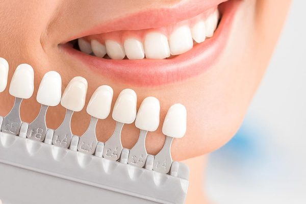 blanqueamiento dental